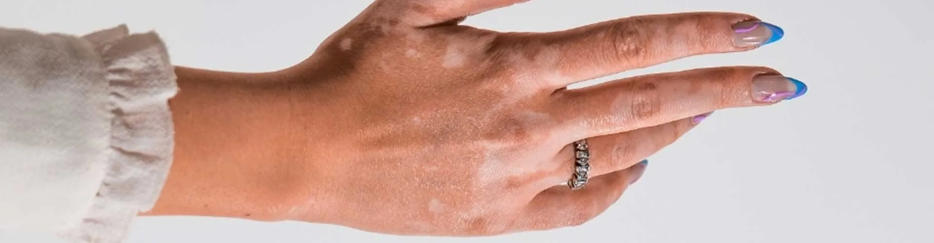 Vitiligo başlangıç evresi nasıl anlaşılır?
