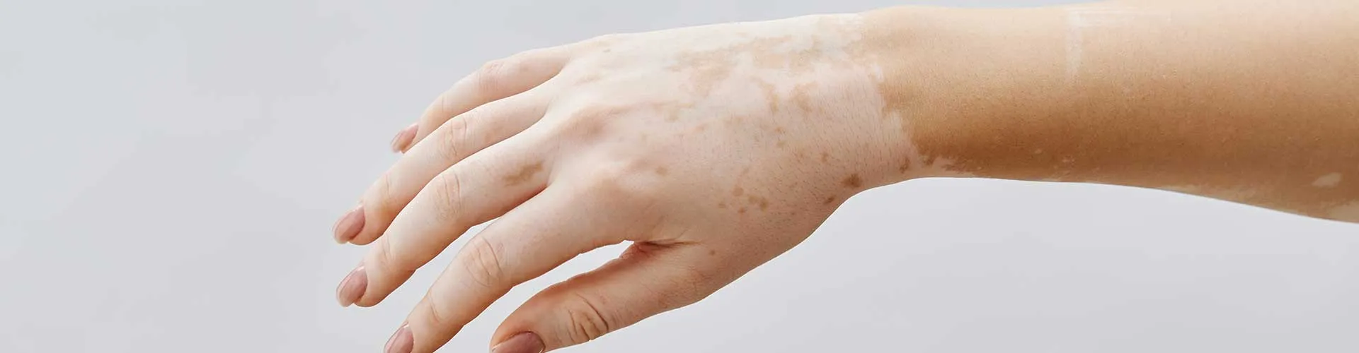 Cilt Beyazlaması Vitiligo Habercisi Olabilir mi?