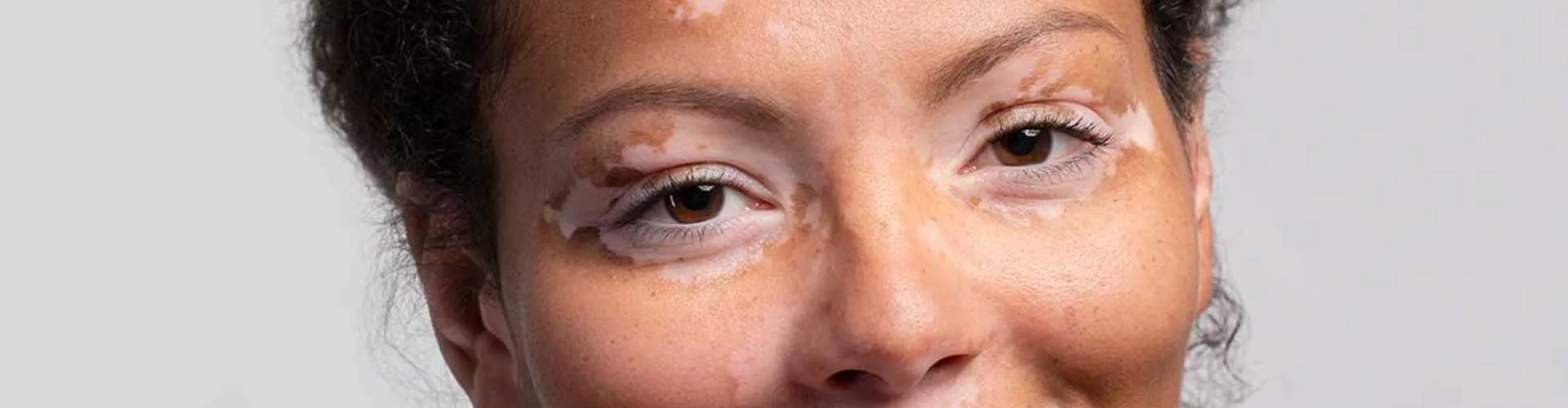 Vitiligo Hastalarında Cilt Bakımı Nasıl Olmalı?