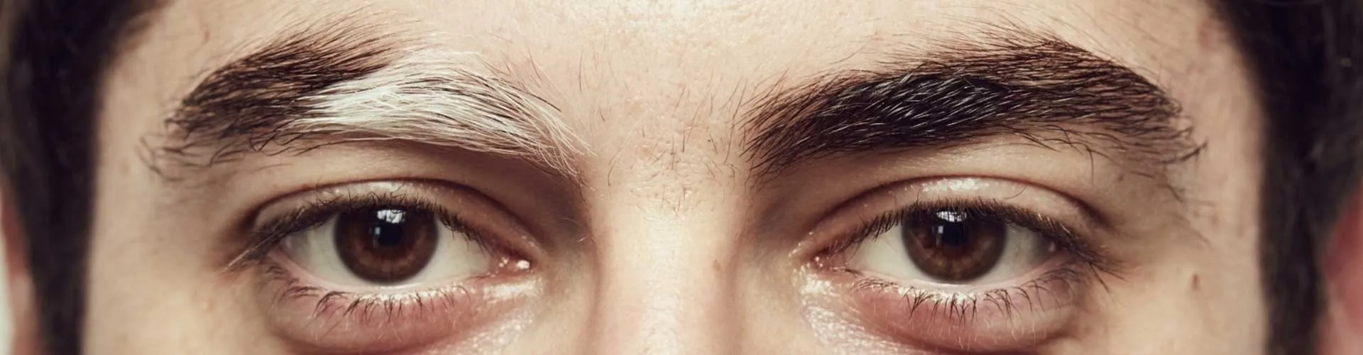 Vitiligo Hastalarında Saç ve Kaşlarda Beyazlama: Nedenleri ve Tedavi Seçenekleri