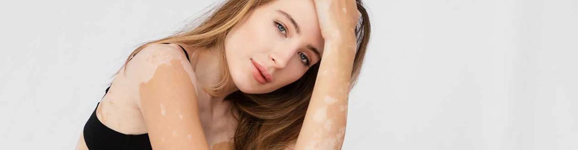 Vitiligo İlerler mi? Hastalığın Seyri ve Kontrol Altına Alma Yöntemleri