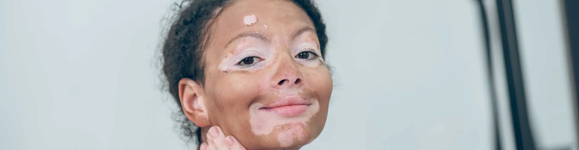Vitiligo Tanısı Nasıl Konulur? Hangi Testler Yapılır?