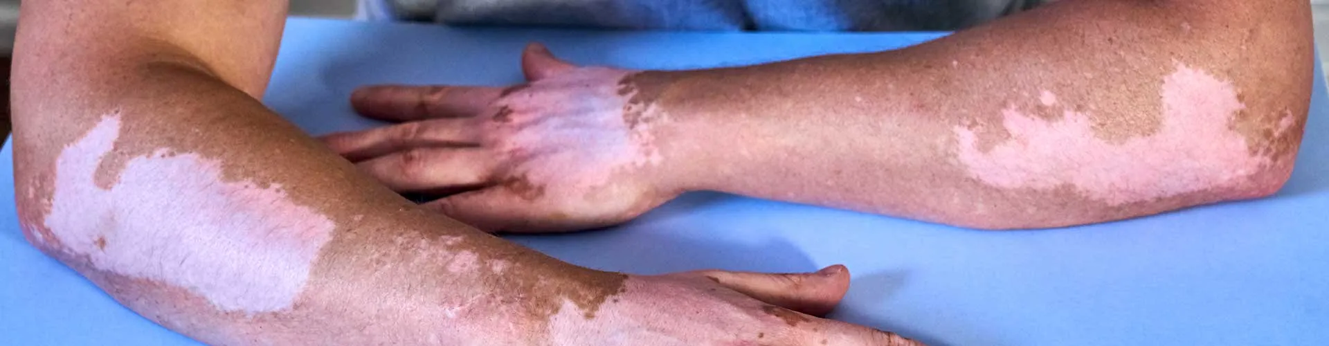 Vitiligo ve Stres Arasında Nasıl Bir İlişki Vardır?