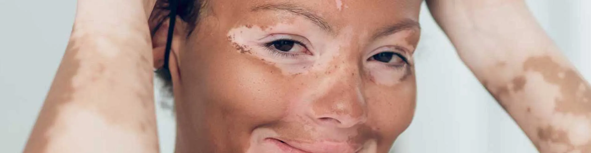 Vitiligo Vücutta En Çok Nerelerde Görülür?