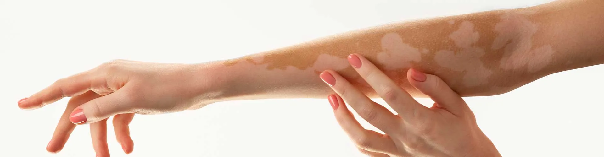 Vitiligo nedir? Belirtileri, nedenleri ve tedavi seçenekleri