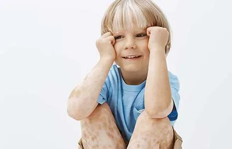 Çocuklarda Vitiligo: Belirtiler ve Yaklaşım Yöntemleri