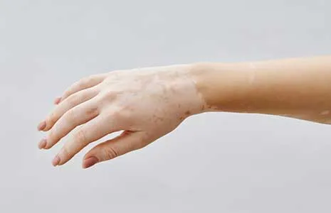 Cilt Beyazlaması Vitiligo Habercisi Olabilir mi?