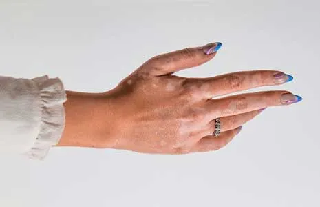 Vitiligo başlangıç evresi nasıl anlaşılır?