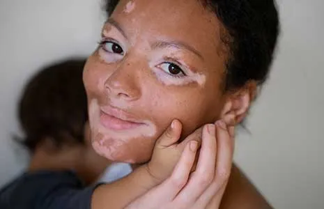 Vitiligo Genetik mi? Aileden Geçiş Olasılığı Hakkında Bilimsel Gerçekler