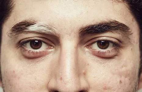 Vitiligo Hastalarında Saç ve Kaşlarda Beyazlama: Nedenleri ve Tedavi Seçenekleri