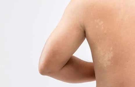 Vitiligo ile Karıştırılan Hastalıklar Nelerdir?