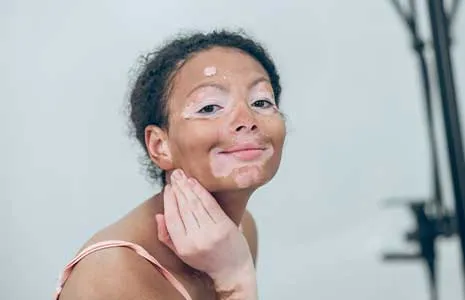 Vitiligo Tanısı Nasıl Konulur? Hangi Testler Yapılır?