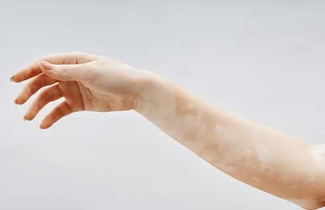 Vitiligo Tedavisinde En Güncel Yöntemler Nelerdir?