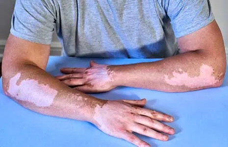 Vitiligo ve Stres Arasında Nasıl Bir İlişki Vardır?