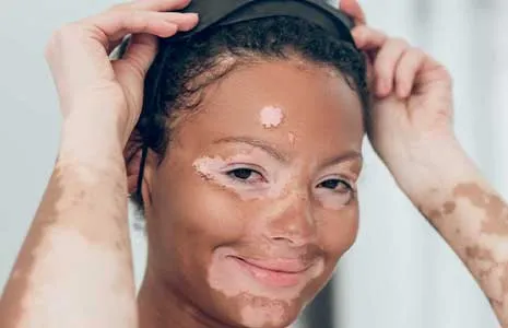 Vitiligo Vücutta En Çok Nerelerde Görülür?